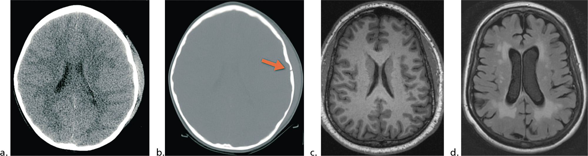 Neuroimaging Techniques